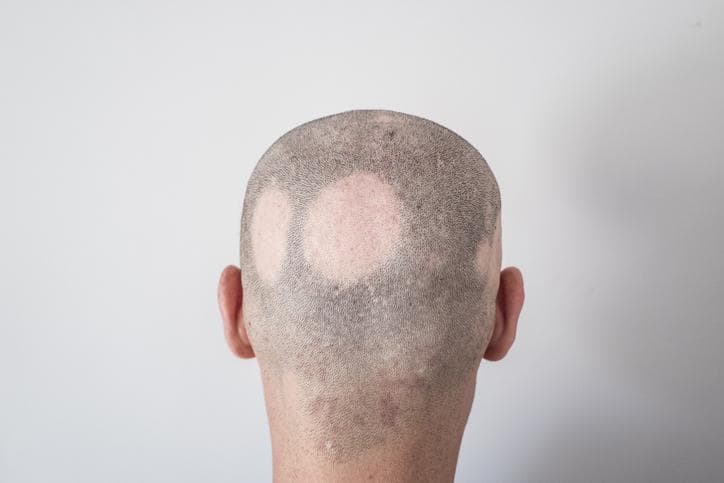 Alopecia